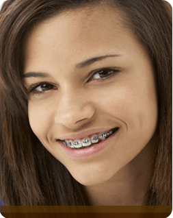 Top Braces Types Compared: Find Your Ideal Match Now