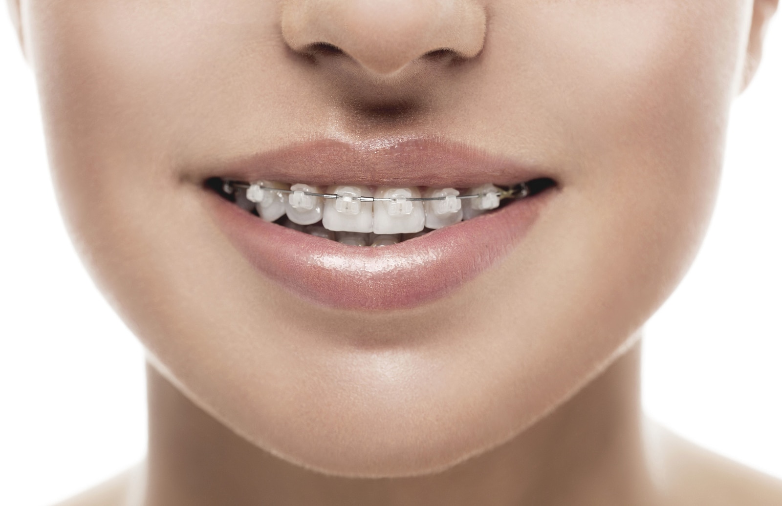 average cost of braces monroe ny