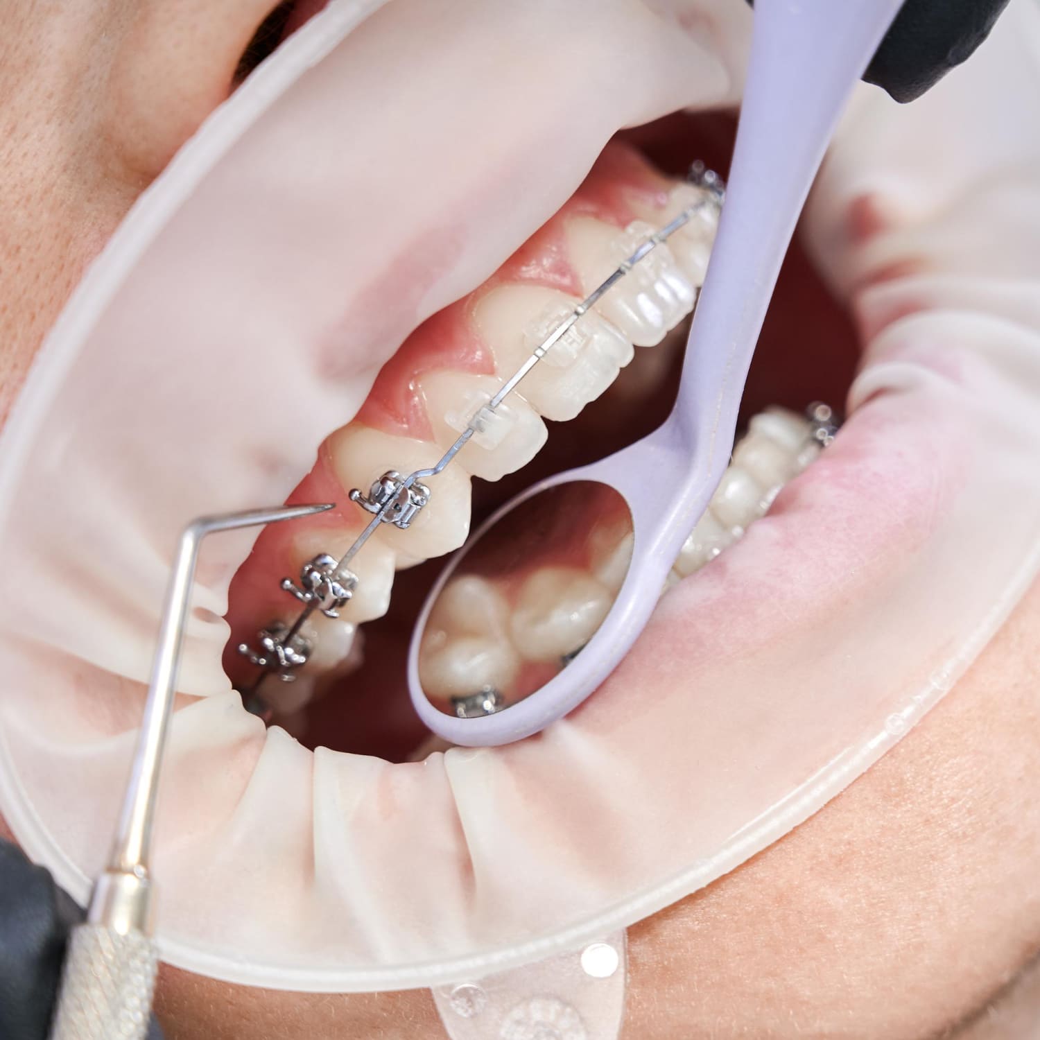 Top Braces Types Compared: Find Your Ideal Match Now