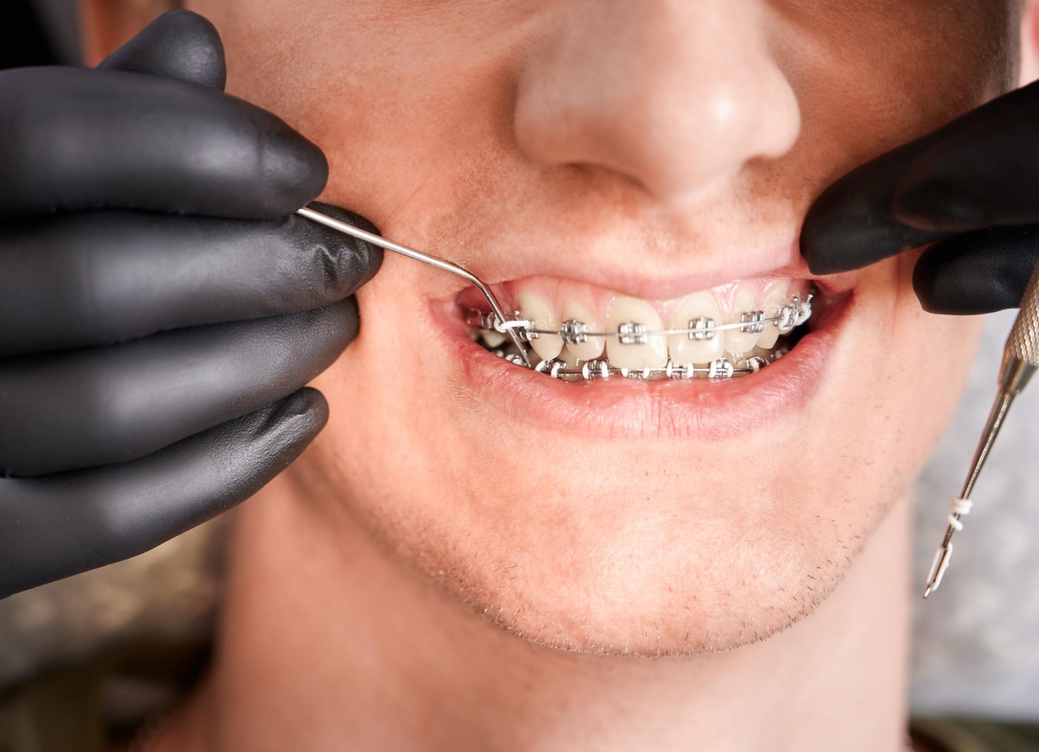 cost to get braces in new york